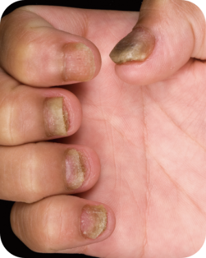 乾癬、爪の病変症状